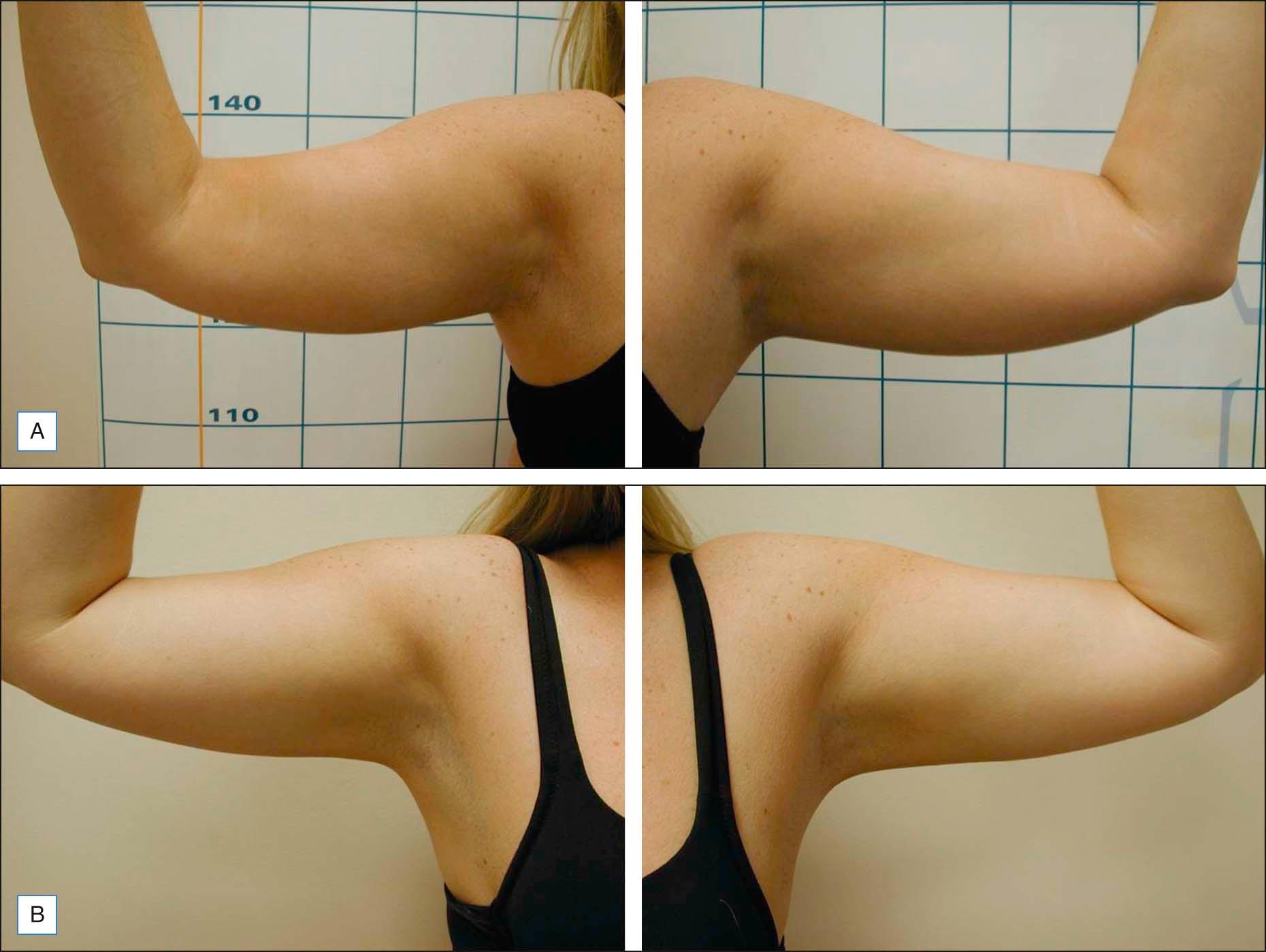 Figure 10.3, (A ) Before and ( B ) 3 months after laser-assisted lipolysis to the arms; right arm (left), left arm (right)