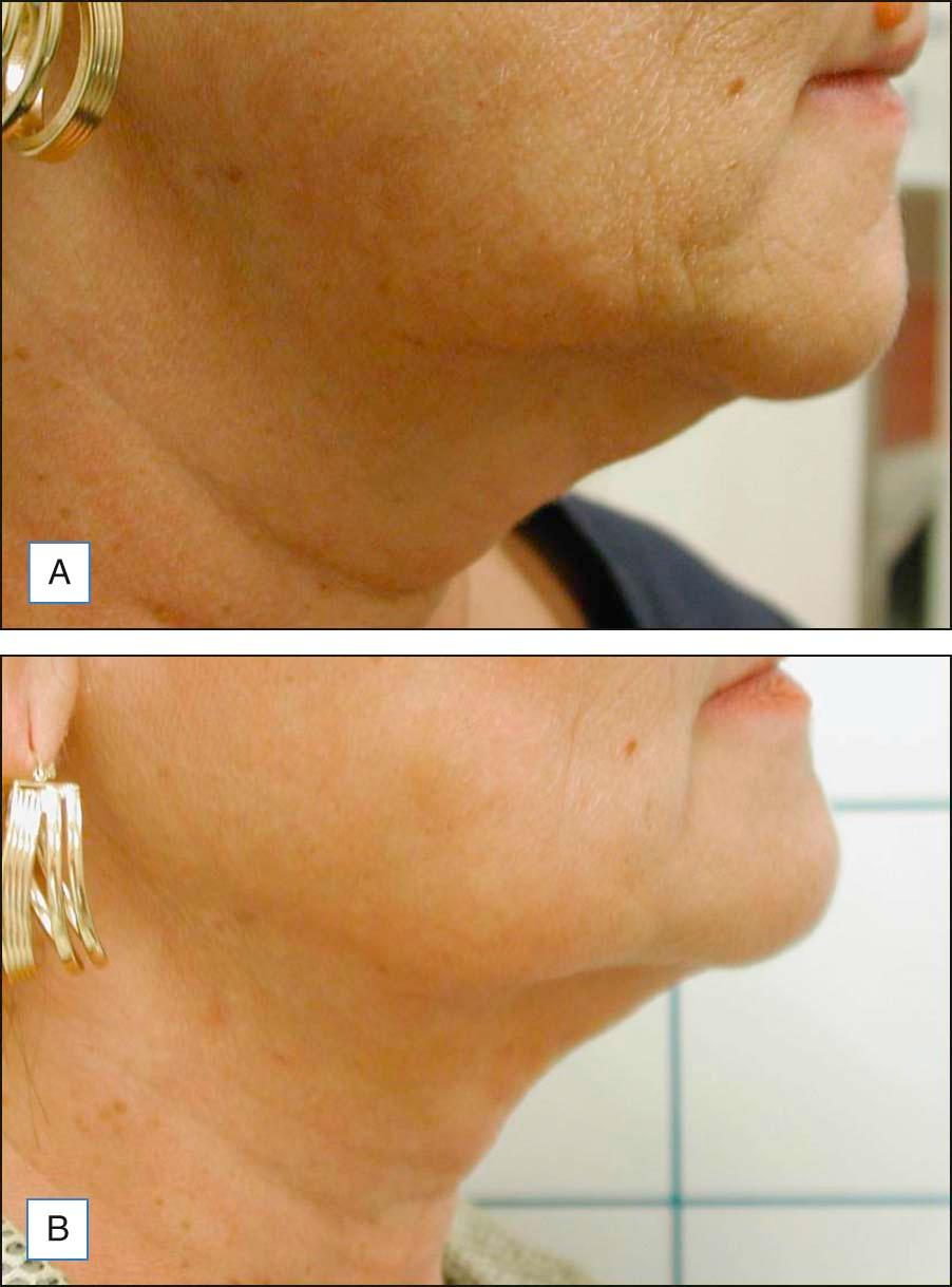 Figure 10.4, (A ) Before and ( B ) 3 months after laser-assisted lipolysis to the submental and jowl area