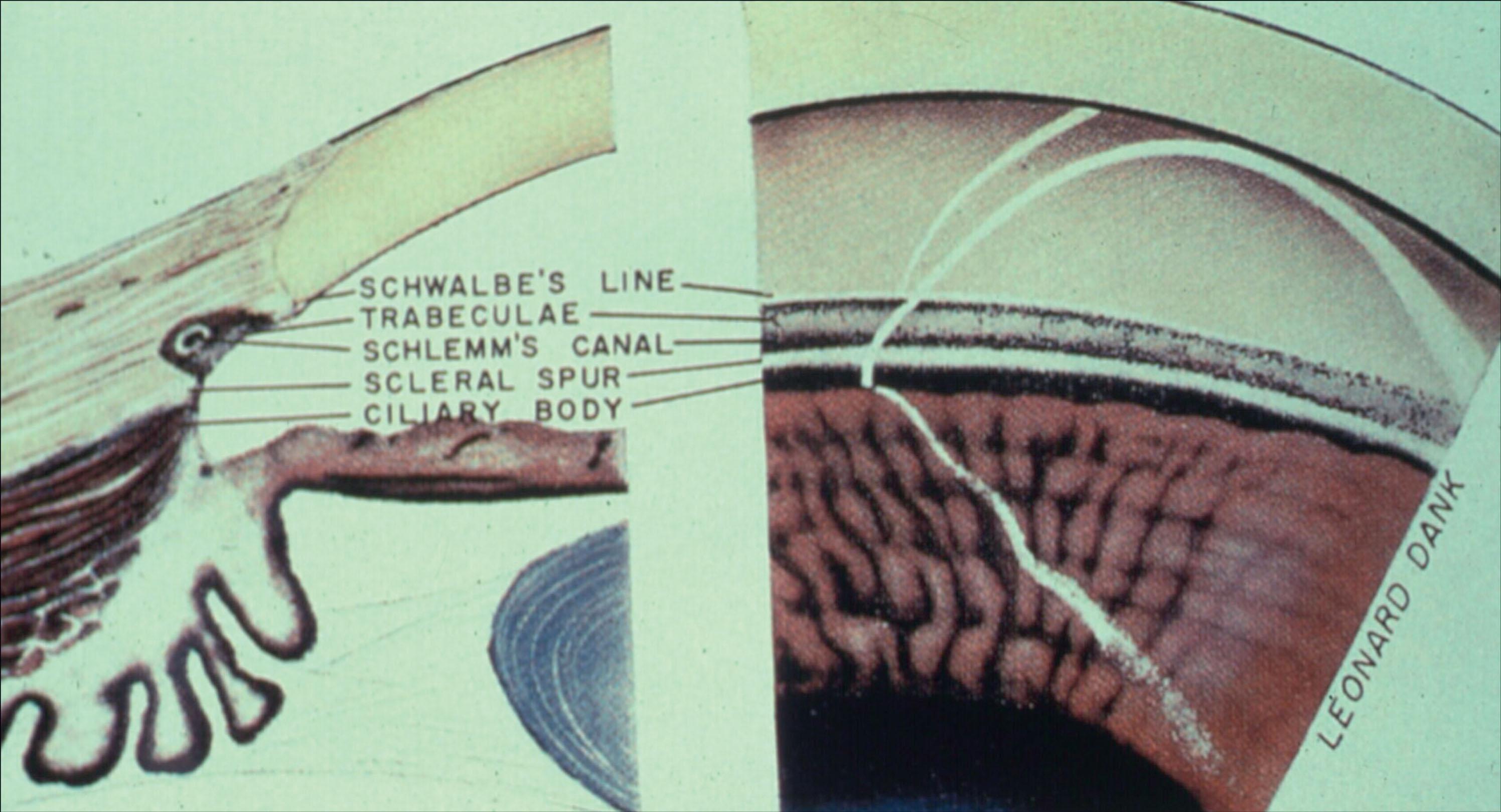 Fig. 10.23.1, Corneal Wedge Reflex.