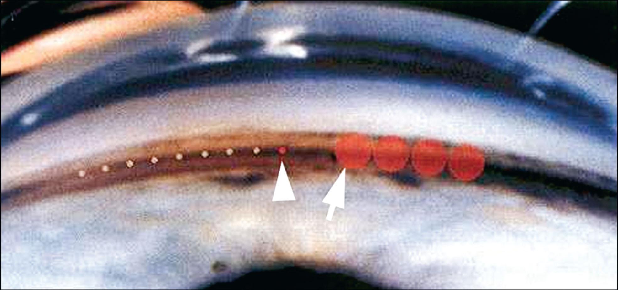 Fig. 10.23.3, Selective laser trabeculoplasty (arrow) versus argon laser trabeculoplasty treatment (arrowhead) .