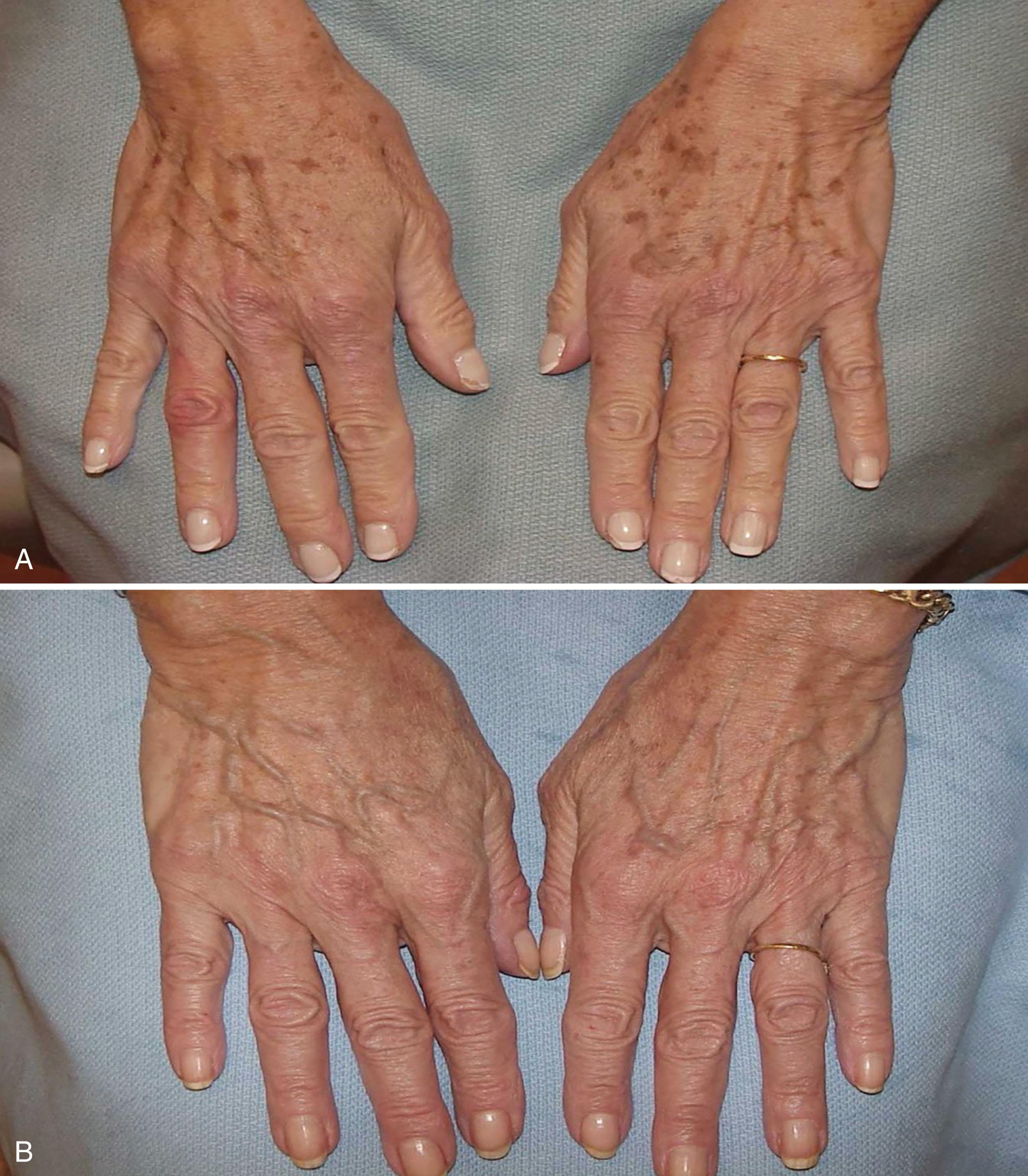 Fig. 3.1, Solar lentigines on the dorsal hands (A) significantly improved after two treatments with the 532 nm Q-switched device (B).