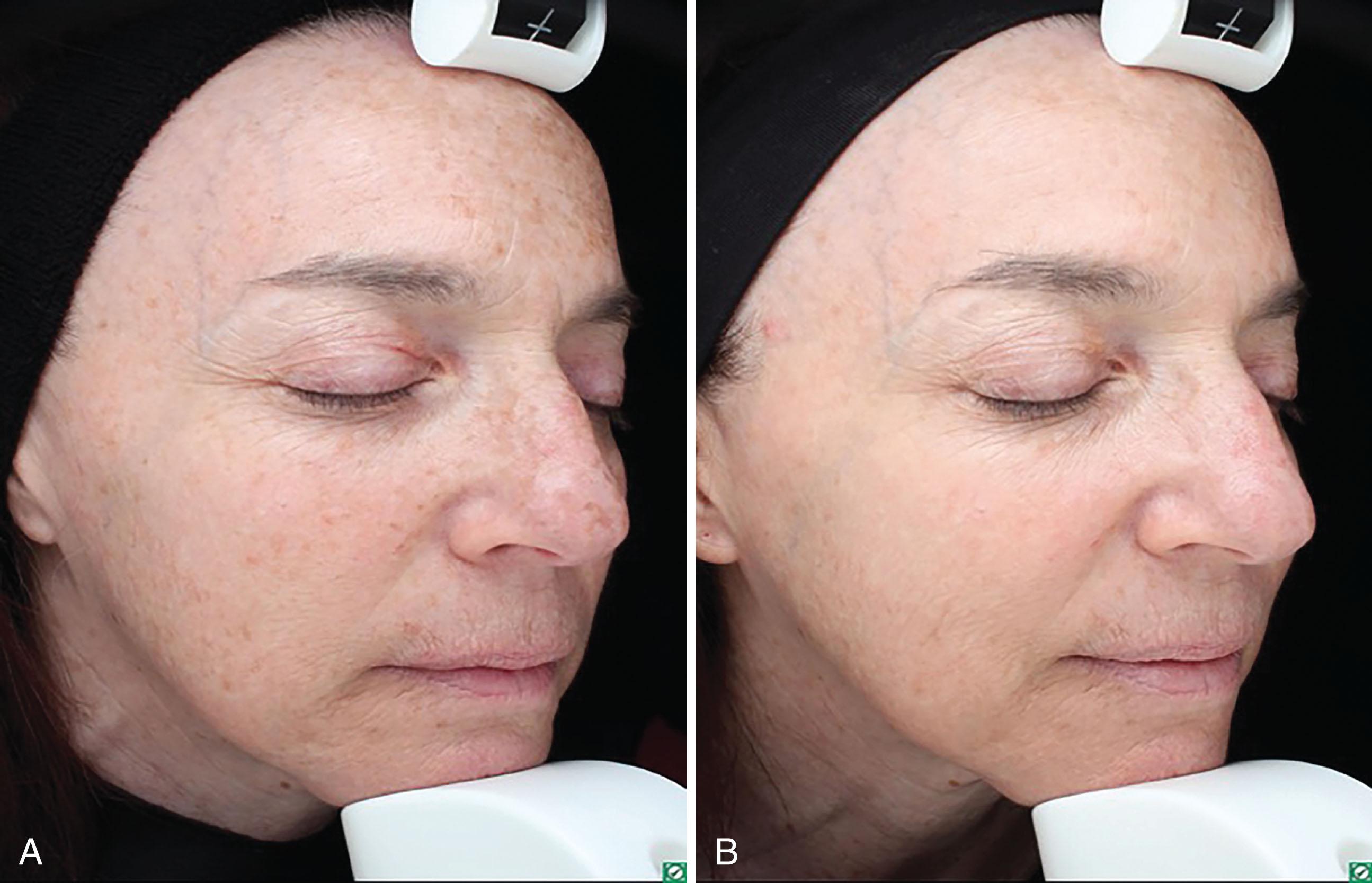 Fig. 3.2, Solar lentigines and photodamage of the face seen at baseline (A) and 1 month after four treatments with the 755 nm picosecond device (B).