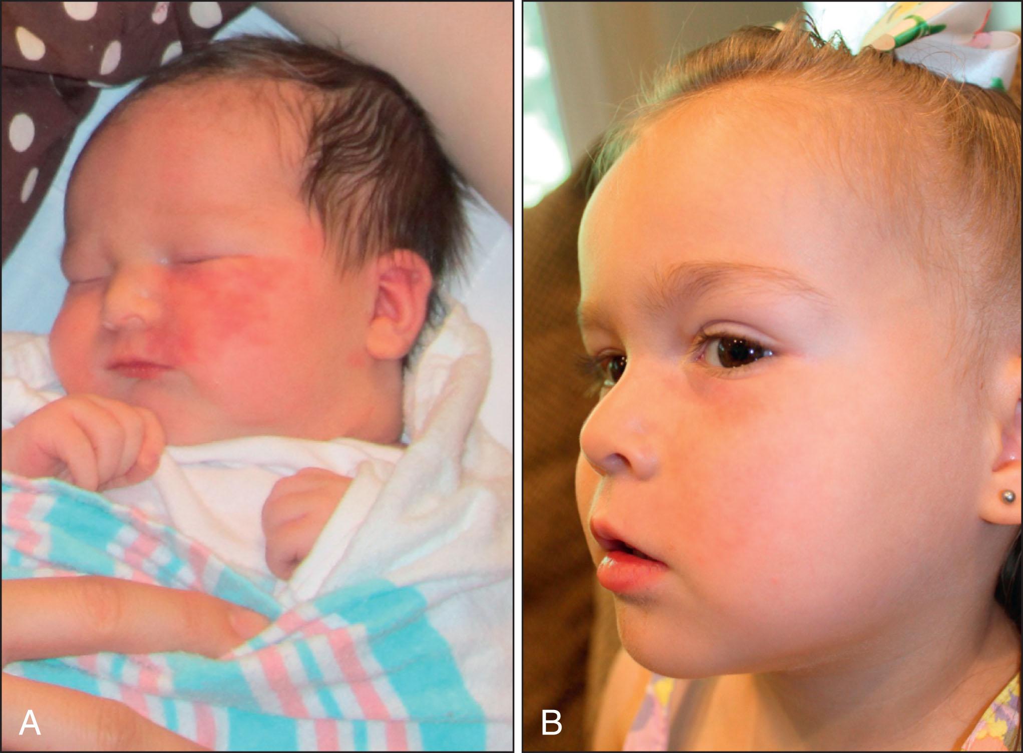 Fig. 2.3, Port-wine birthmark: (A) before and (B) after PDL treatments.