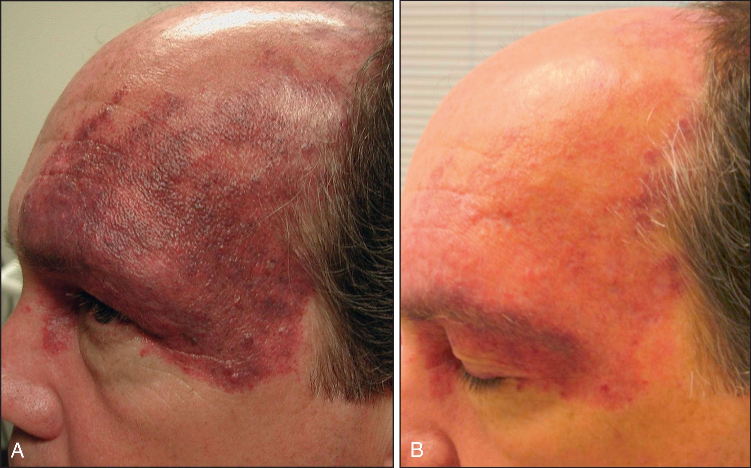 Fig. 2.4, Violaceous, hypertrophic port-wine birthmark: (A) before and (B) after alexandrite laser treatments. Note improvement in color and thickness.