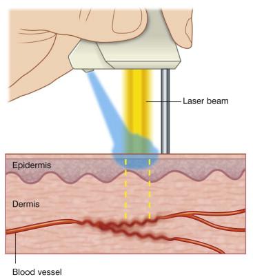 FIGURE 35.2, The Dynamic Cooling Device (DCD; Candela Laser Corp) provides a brief spurt of cryogen that selectively cools the epidermis during Vbeam laser application.