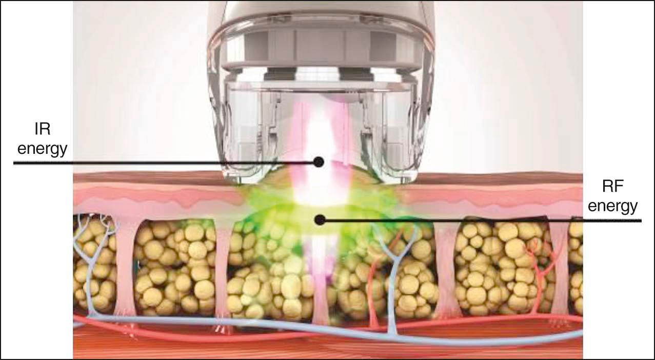 Figure 14.1, Schematic representation of the VelaShape™ III technology