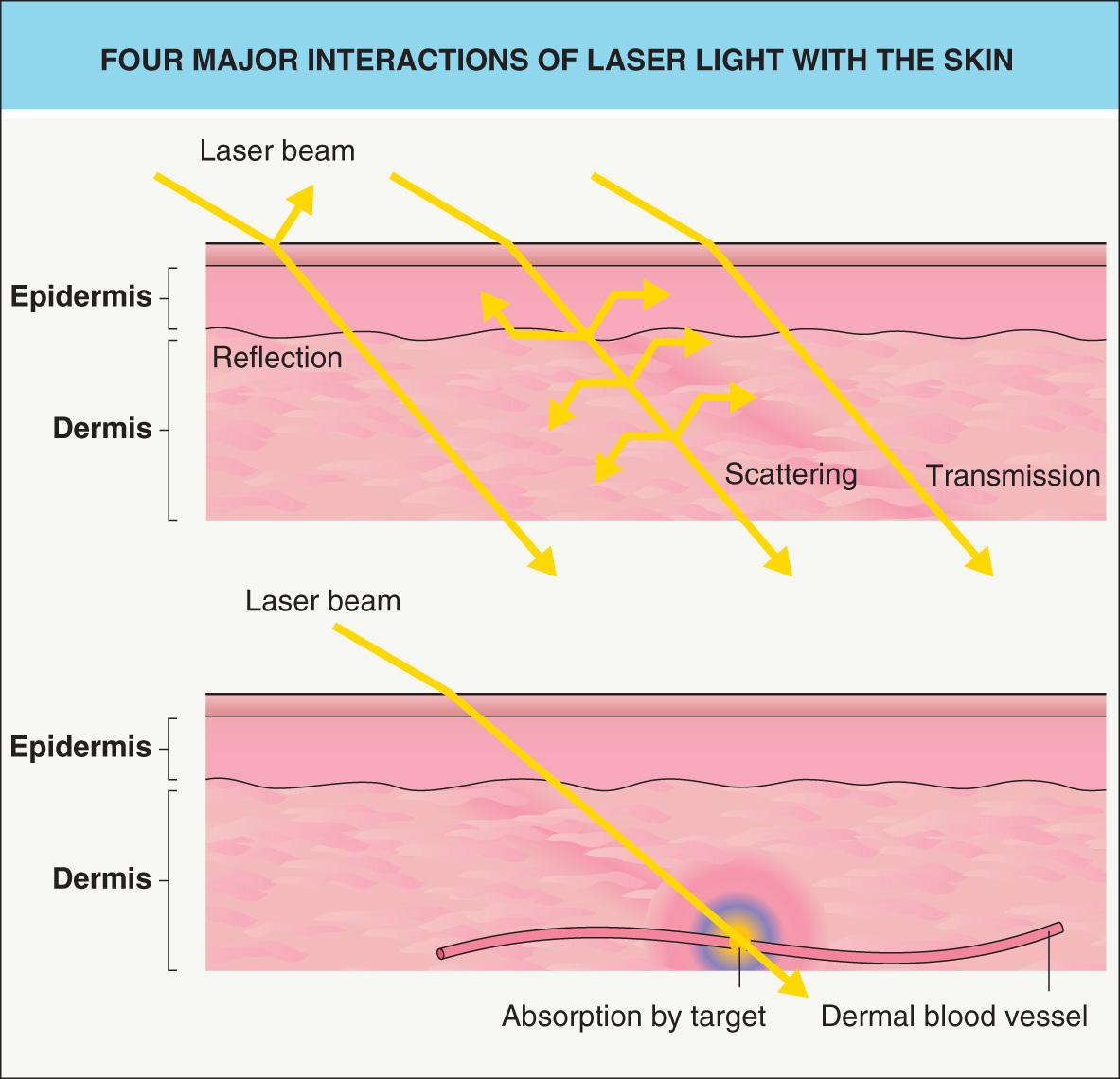 Fig. 136.2, Four major interactions of laser light with the skin.