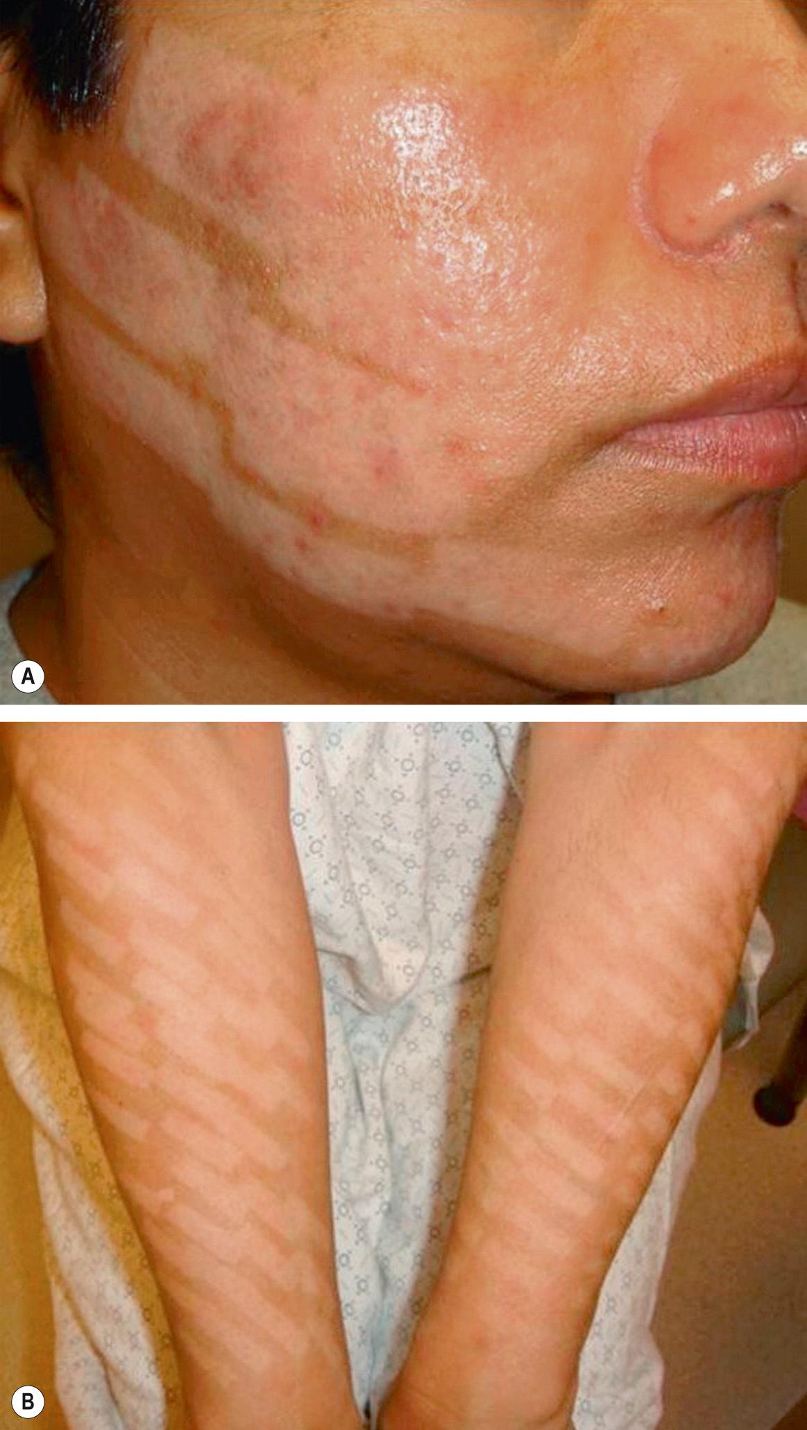 Fig. 137.3, Dyspigmentation with potential for scarring due to inappropriate intense pulsed light (IPL) treatments of the face (A) and arms (B) in two patients with darker skin phototypes.
