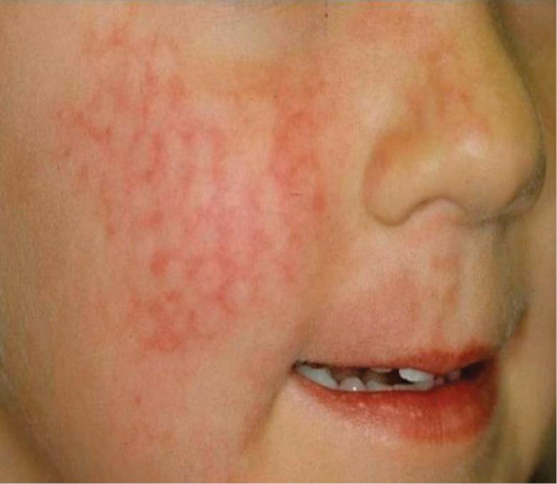 Fig. 137.7, “Footprinting” on the cheek of a young girl following pulsed dye laser therapy of a port-wine stain.