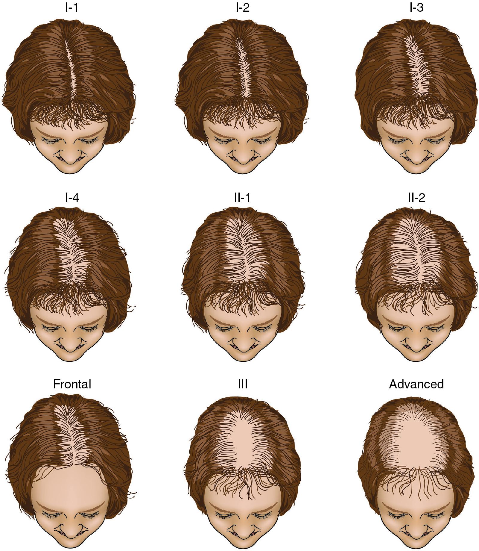 Fig. 15.1, The Savin scale is commonly used to assess female-pattern hair loss.