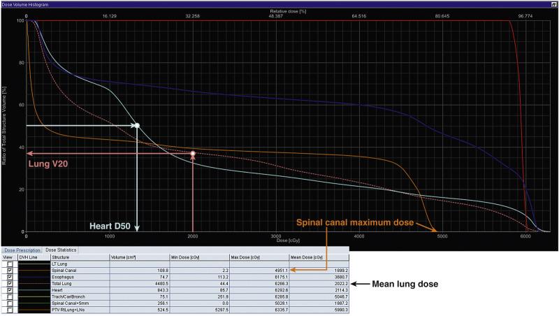 Fig. 18.1, Illustration of Vx, Dx, and Dmax. Mean organ dose is calculated by averaging the dose to each voxel of a tissue and is generally calculated by the treatment planning software. The volume of lung receiving > 20 Gy (V20) and mean lung dose are shown (37% and 20.2 Gy, respectively). The dose to 50% of the heart (D 50 ) is shown (13.3 Gy), which is not a commonly used dose-volume metric but is presented for illustrative purposes. The maximal dose to the spinal canal is depicted as well (49.5 Gy).