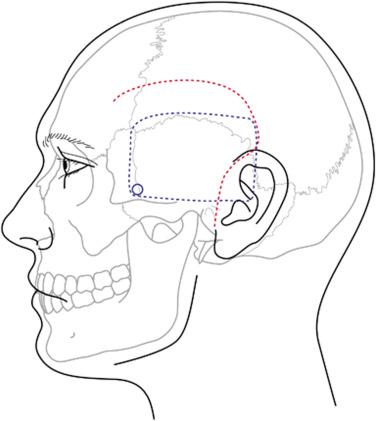 Figure 15.1, Patient position and incision. Patient positioning is either lateral or supine with a shoulder roll with the head turned fully to the opposite side. The scalp incision with underlying position of the craniotomy is shown.