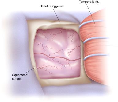 Figure 15.2, After craniotomy, the temporalis muscle and fascia are mobilized anteriorly as described to clear a flat view across the floor of the middle fossa after dural elevation in the extradural approach.