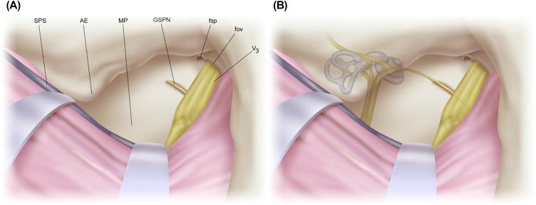 Figure 15.3, Extradural option. (A) After initial dural elevation from the floor of the middle fossa, the arcuate eminence (AE), meatal plane (MP), greater superficial petrosal nerve (GSPN), and middle meningeal artery at the foramen spinosum are exposed, which is adequate for the standard middle fossa approach; however, much broader exposure is required for the extended middle fossa approach. The key maneuver to a broader middle fossa view is separation of the dura propria from the mandibular nerve and lateral Gasserian ganglion in the lateral wall of the cavernous sinus. (B) The location of the internal auditory canal, the cochlea, and semicircular canals is shown deep in the bone. fov , foramen ovale; fsp , foramen spinosum; SPS , superior petrosal sinus; V 3 , mandibular division cranial nerve V.