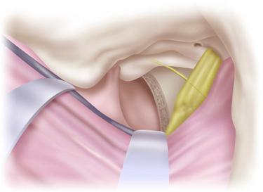 Figure 15.4, Bone removal for the more limited middle fossa approach preserves bone over the horizontal petrous carotid artery and the petrous apex.