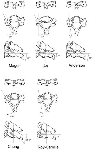 FIGURE 43-1, Comparison of the entry points and screw trajectories described by various authors. The black dots indicate the entry points for the lateral mass screws.