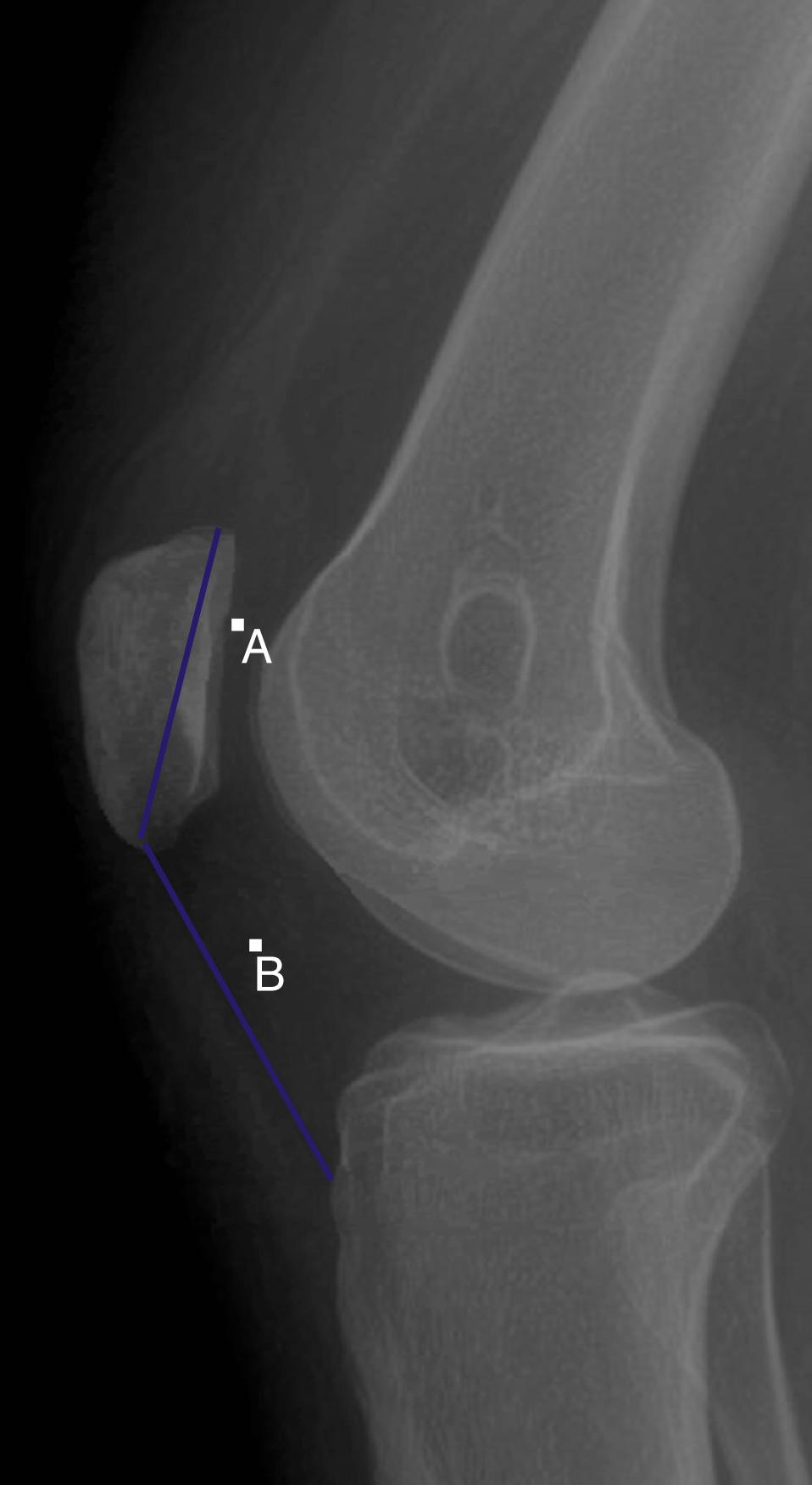 Fig. 30.1, The Insall-Salvati Index is calculated by dividing the length of the patella (line A) by the measurement of the length of the patella tendon (line B) on lateral radiograph.