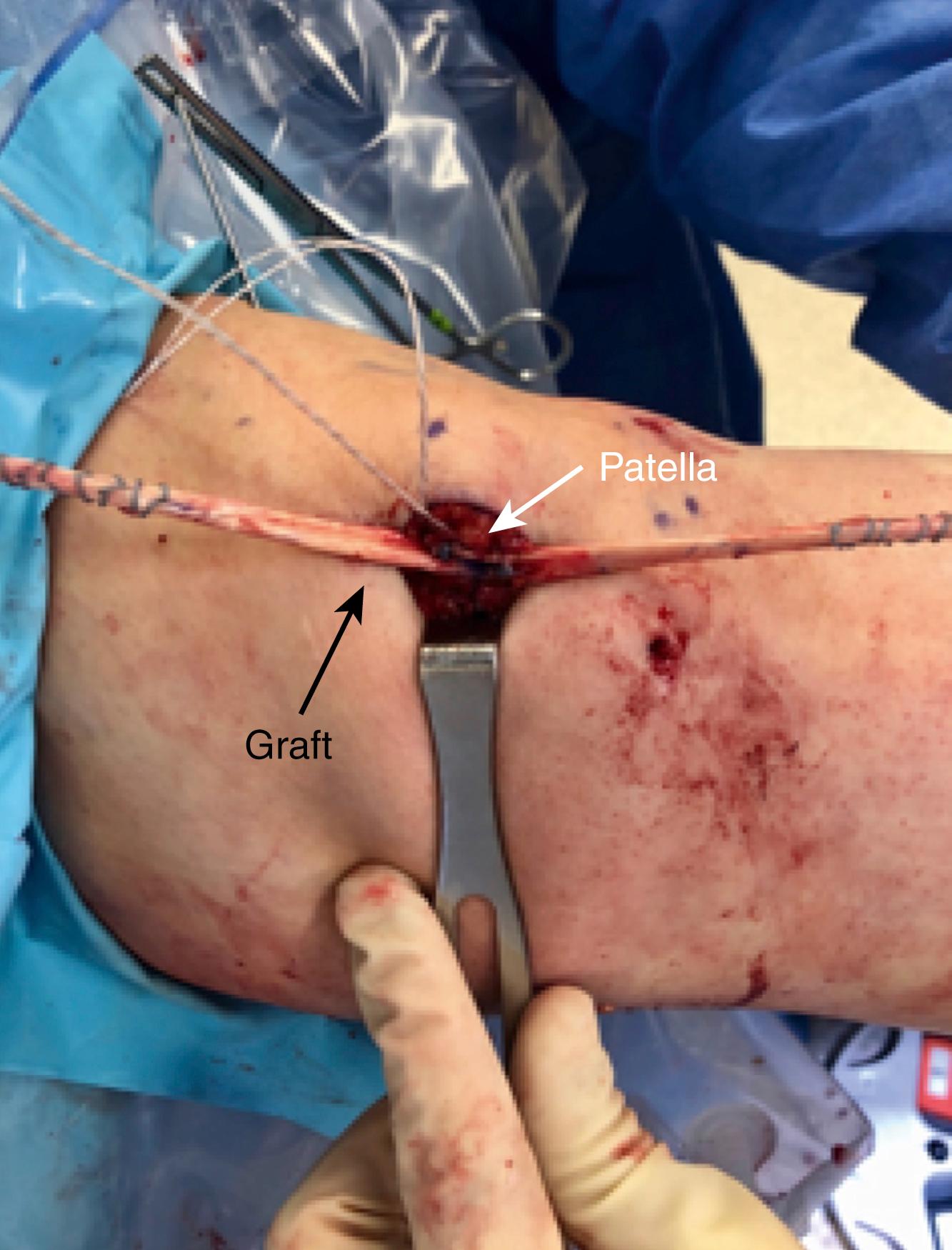 Fig. 30.11, Fixation of the medial patellofemoral ligament (MPFL) graft to the patella.
