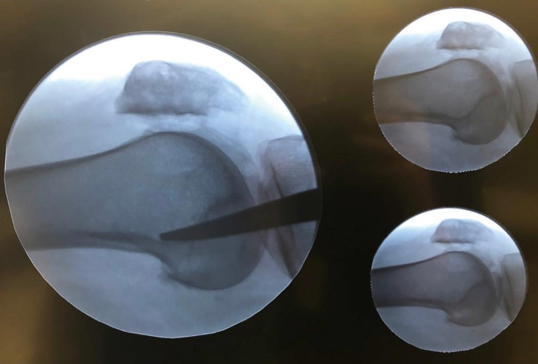 Fig. 30.12, Identifying Schottle point for fixation of the medial patellofemoral ligament (MPFL) graft (lateral radiographs).