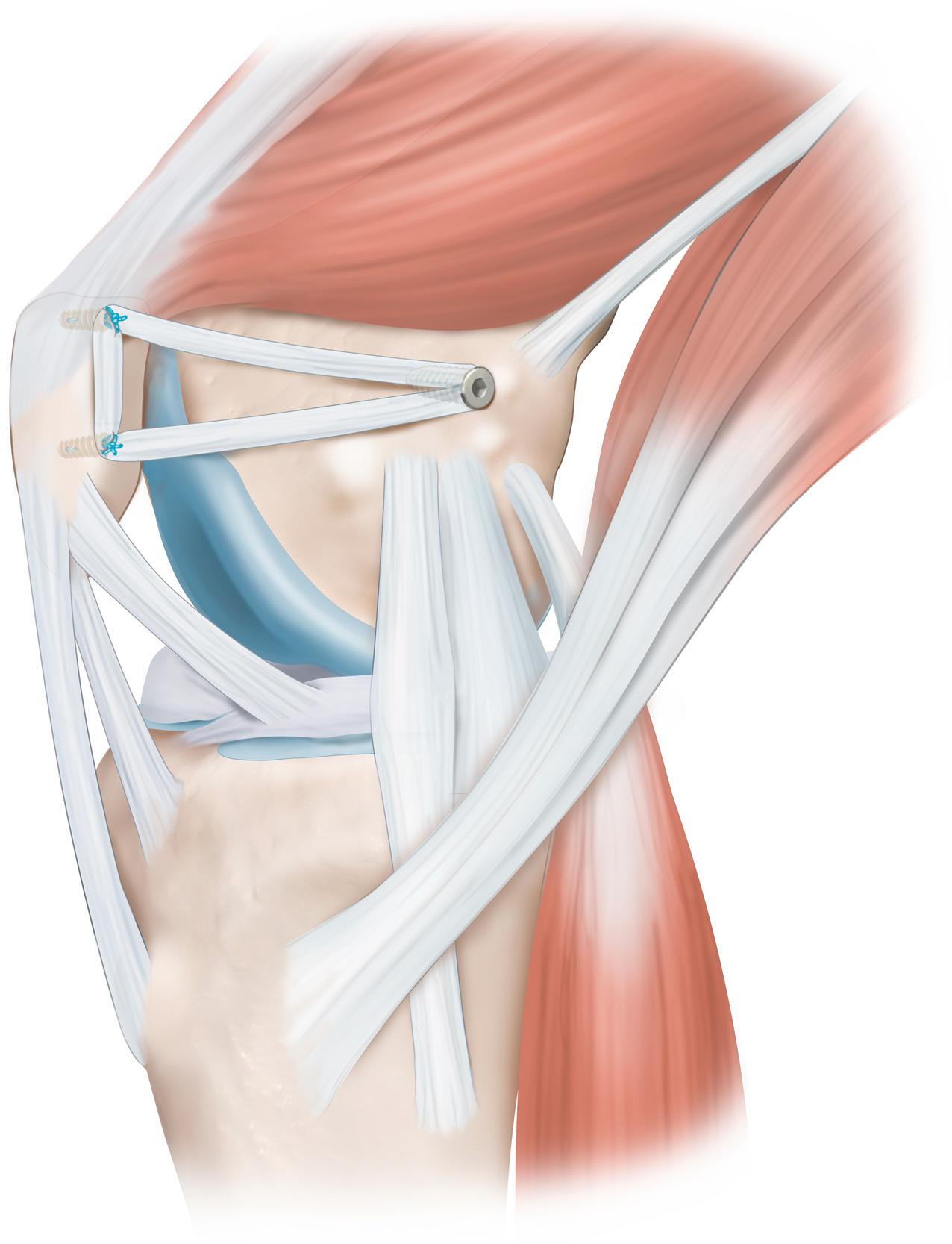 Fig. 30.14, Right knee illustration demonstrating an medial patellofemoral ligament reconstruction with an onlay technique on the patella (2 anchors) and a pullout technique on the femur.