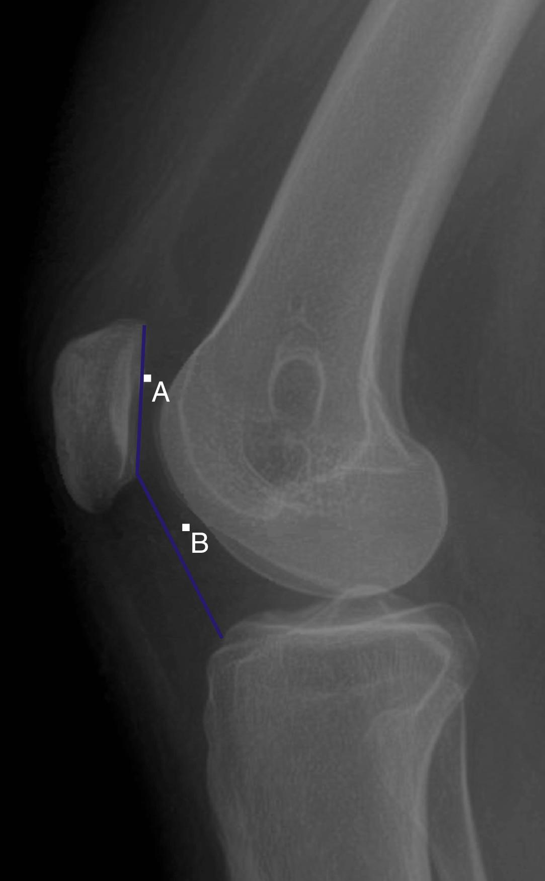 Fig. 30.2, The Canton-Deschamps Index is calculated by dividing the length of the patellar articular surface (line A) by the distance from the lower pole of the patella to upper tibia (line B) on lateral radiograph.