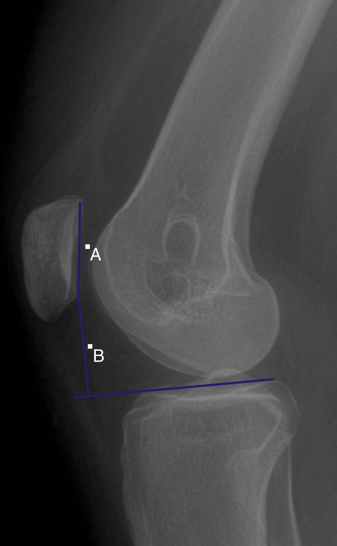 Fig. 30.3, The Blackburn-Peel Index is calculated by dividing the distance from the lower patellar articular surface to a line drawn perpendicularly from the upper tibia (line B) by the patellar articular surface length (line A) on lateral radiograph.