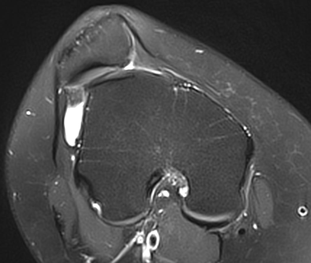 Fig. 30.4, An example of high-grade trochlear dysplasia on an axial T2 magnetic resonance imaging (MRI; right knee).