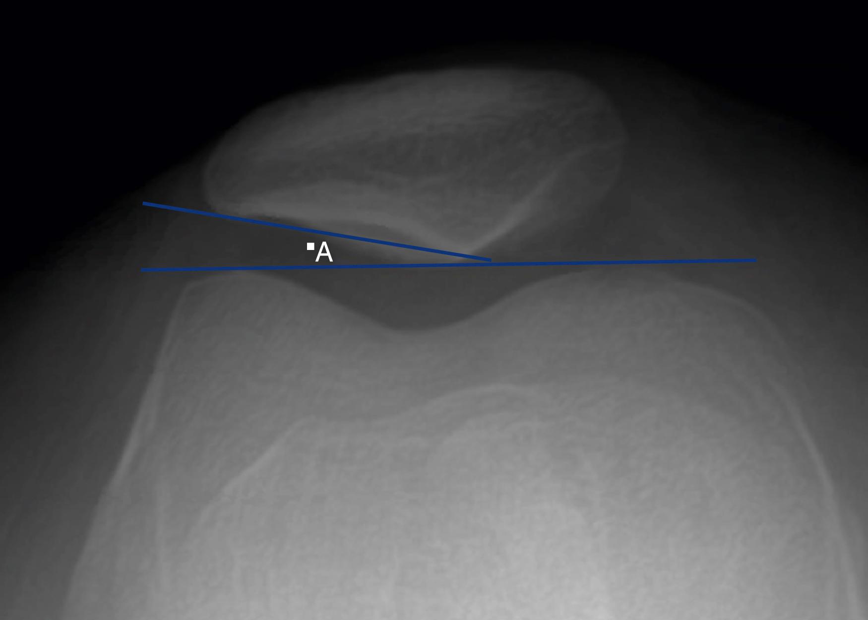 Fig. 30.5, Lateral patellofemoral angle measured on a Merchant view radiograph (A) . This angle is the intersection created by drawing a line connecting the anterior aspects of the femoral condyles and a line along the patellar lateral surface.