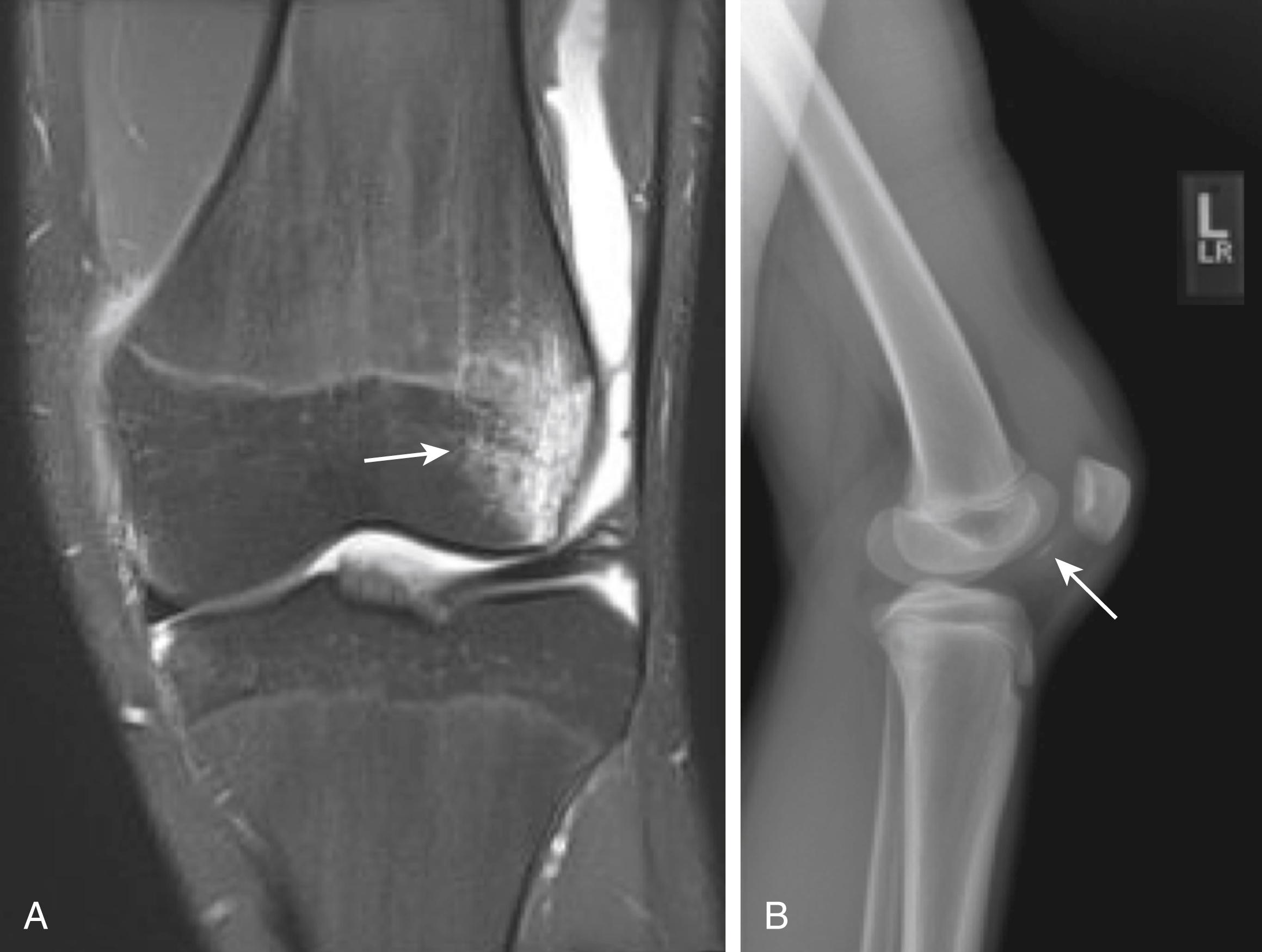 Fig. 30.6, Patella dislocation demonstrating bone oedema pattern (A, arrow ) and loose bodies (B, arrow ).