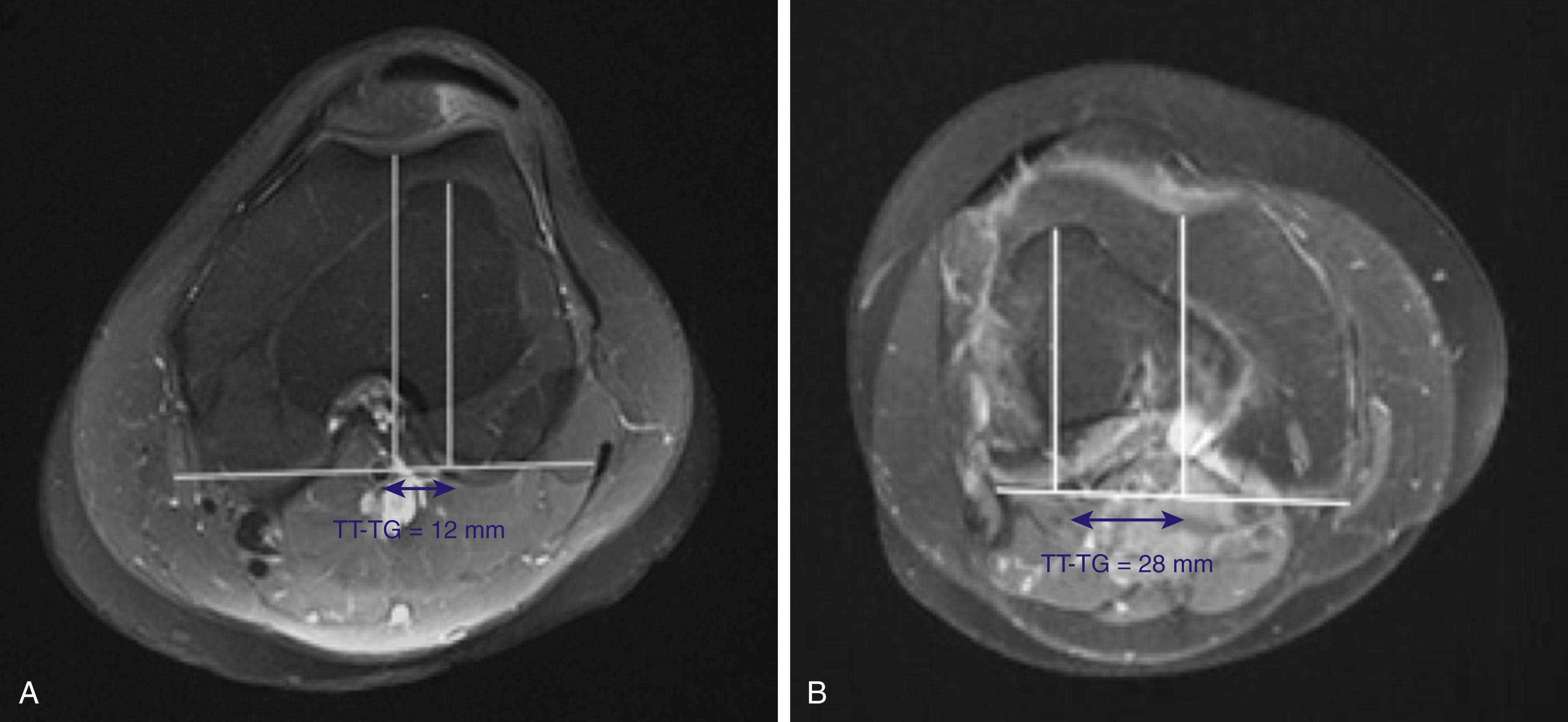 Fig. 30.7, Magnetic resonance imaging (MRI) tibial tubercle–trochlear groove (TT-TG) distance at (A) normal (TT-TG = 12 mm) and (B) abnormal (TT-TG = 28 mm) values on axial T2 MRI.