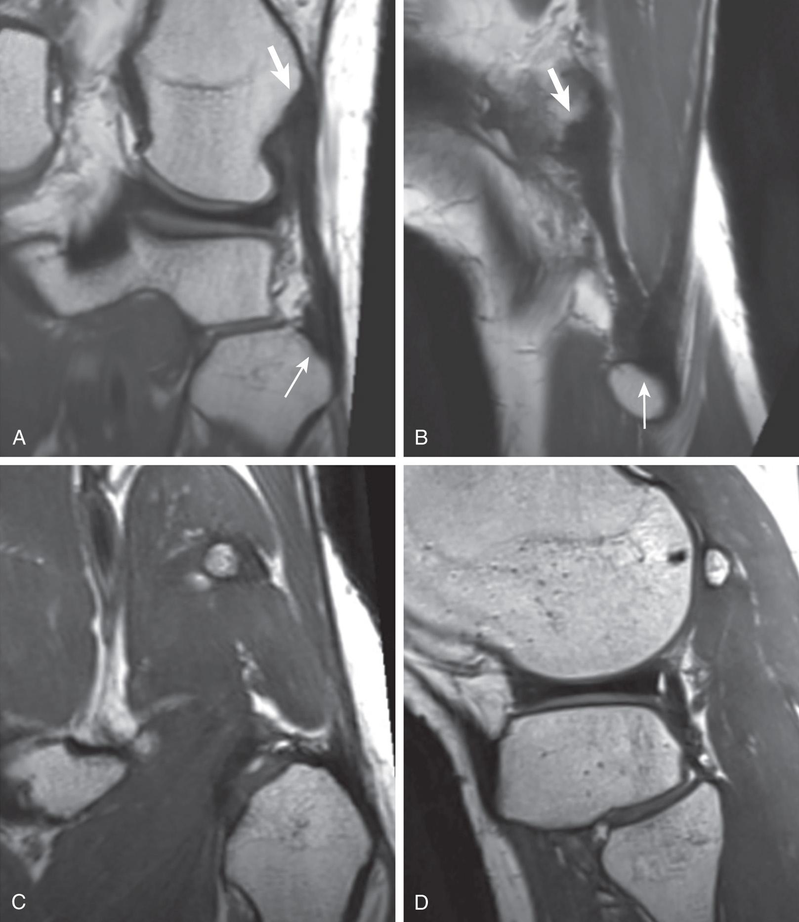 FIG 10.1, Left Knee of a 35-Year-Old Man Imaged With 3D SPACE Sequence Using Voxel Dimensions of 0.47 × 0.47 × 0.58 mm 3