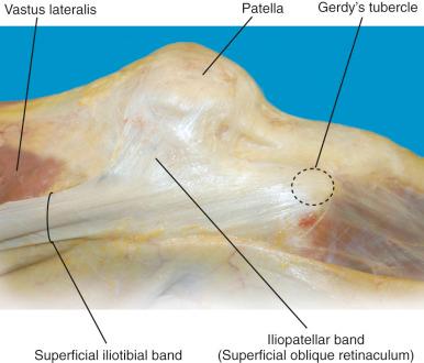 FIG 2-2, Lateral aspect of the knee demonstrates the iliotibial band with its distal insertion on Gerdy's tubercle and the iliopatellar fibers.