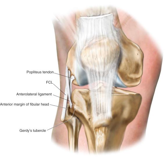 FIG 2-4, The osseous landmarks and attachment sites of the main structures of the lateral knee (iliotibial band and nonanterolateral ligament-related capsule removed, lateral view, right knee). The anterolateral ligament attached posterior and proximal to the fibular collateral ligament femoral attachment and coursed anterodistal to its anterolateral tibial attachment between the center of Gerdy's tubercle and the anterior margin of the fibular head. The short head of the biceps femoris tendon had a direct arm that attached to the fibular head and an anterior arm that attached to the anterolateral tibia. FCL, Fibular collateral ligament.