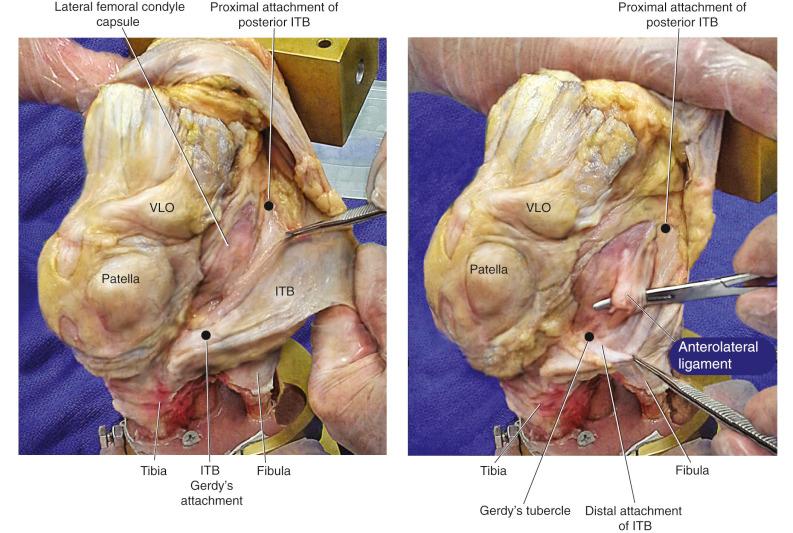 FIG 2-6, The anterolateral ligament (ALL) femoral insertion is just proximal and posterior to the lateral femoral epicondyle. The ALL tibial insertion is on the anterolateral tibia, midway between Gerdy's tubercle and the tip of the fibular head. ITB, Iliotibial band; VLO, vastus lateralis obliquus.