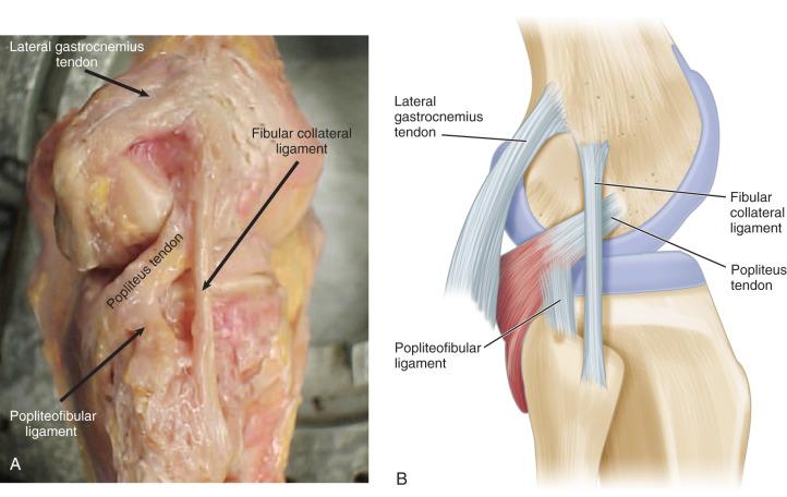 Fig. 102.1, Image (A) and illustration (B) of the anatomy of the posterolateral corner and the relationships of individual structures to each other.