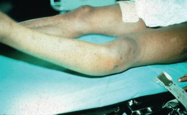 Fig. 102.5, An example of the external rotation recurvatum test showing severe posterolateral corner injury.
