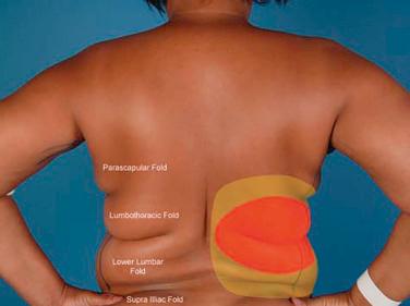 Fig. 8.2, Photograph showing the fat compartments related to the latissimus dorsi flap on the patient's left side. Note the design of the extended latissimus dorsi skin paddle in red and the areas of fat harvest noted in yellow. Maximal volume can be obtained by incorporating two soft tissue rolls or fat compartments within the skin paddle design.