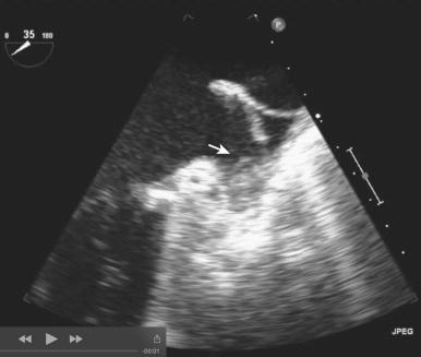 Fig. 50.1, A left atrial appendage thrombus (arrow) in a patient with atrial fibrillation is identified by transesophageal echocardiography.