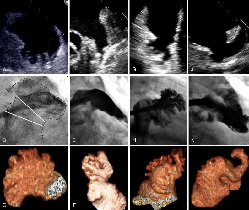 Fig. 50.2, The four morphologic classifications of the left atrial appendage are shown by transesophageal echocardiography (top) , cine-angiography (middle) , and three-dimensional computed tomography (bottom) . (A–C), Cauliflower morphology. (D–F), Windsock morphology. (G–I), Cactus morphology. (J–L), Chicken wing morphology.