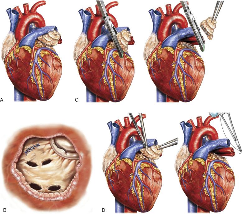 Fig. 50.3, Surgical techniques used to close the left atrial appendage (LAA). (A) Epicardial suture exclusion. (B) Endocardial suture exclusion. (C) Stapled excision, with the stapler positioned across the base of the LAA (left) and the LAA removed with an intact stump (right) . Thrombotic complications may occur if the residual stump is too large. (D) Removal of the LAA by scissors or electrocautery (left) , followed by two-layer suture closure of the LAA stump flush with the heart surface (right) . (Modified from Chatterjee S, Alexander JC, Pearson PJ, et al. Left atrial appendage occlusion: lessons learned from surgical and transcatheter experiences. Ann Thorac Surg. 2011;92:2283–2292.)