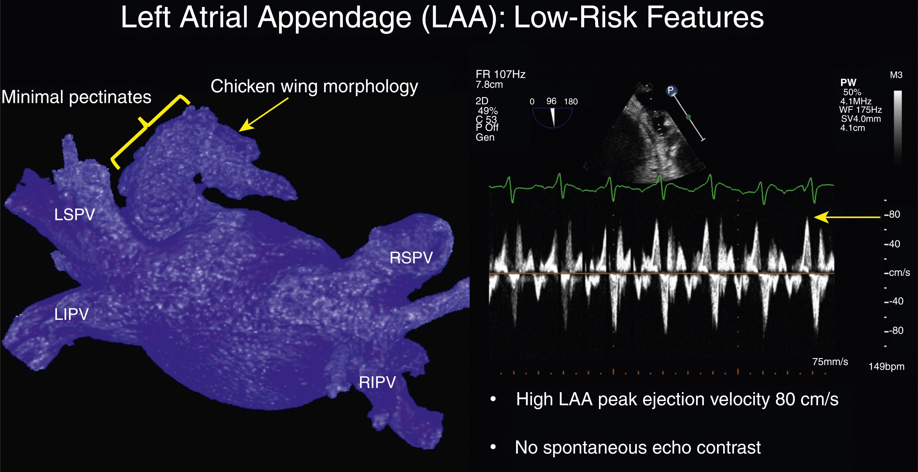 Fig. 77.1, Low-risk LAA for thrombus.