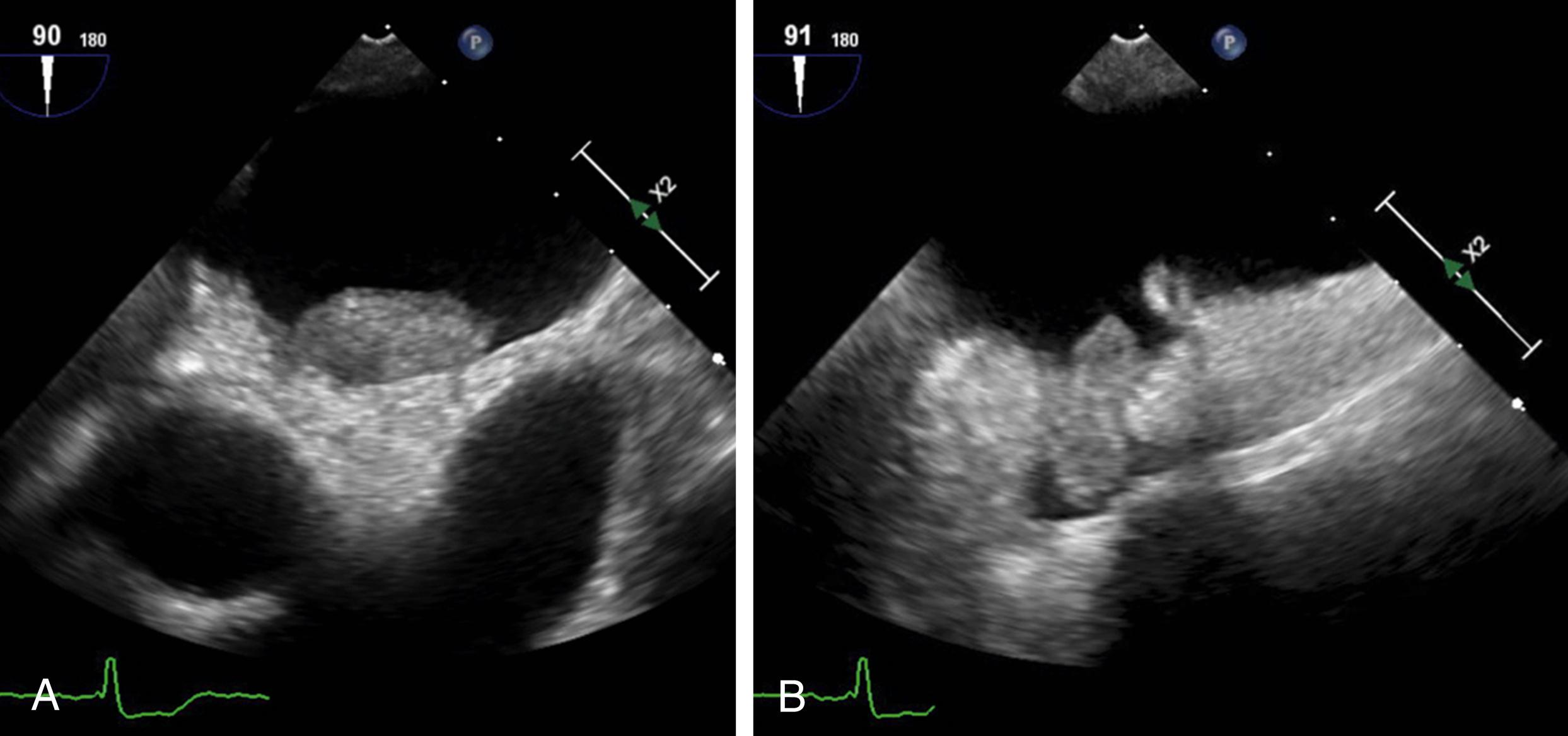 Figure 127.1, A, Large left atrial appendage thrombus. B, Layered left atrial mural thrombus associated with the left atrial appendage thrombus. (Also see Video 127.1A , Video 127.1B .)