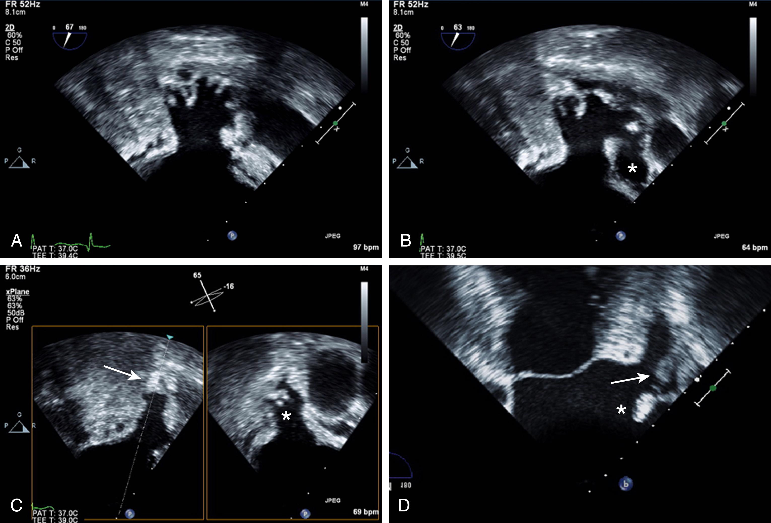 Figure 127.2, Potential diagnostic caveats in imaging of the left atrial appendage (LAA). Prominent pectinate muscles within the LAA ( A ) and a multilobed LAA ( B; additional lobe marked with an asterisk ). C, An apparent “mass” at the tip of the LAA ( left ; arrow ), which may be mistaken for a thrombus. Imaging at an orthogonal plane ( right ), using the transesophageal echocardiography matrix probe with biplane imaging, clearly shows that this mass is caused by normal pectinate muscles (asterisk) . D, Shadowing of the LAA (arrow) by a thickened septum (asterisk) between the LAA and the adjacent left upper pulmonary vein (“Q-tip”; ligament of Marshall), which may appear like a thrombus or obscure a thrombus, causing both false-positive and false-negative diagnoses of an LAA thrombus. (Also see Video 127.2AB , Video 127.2C .)