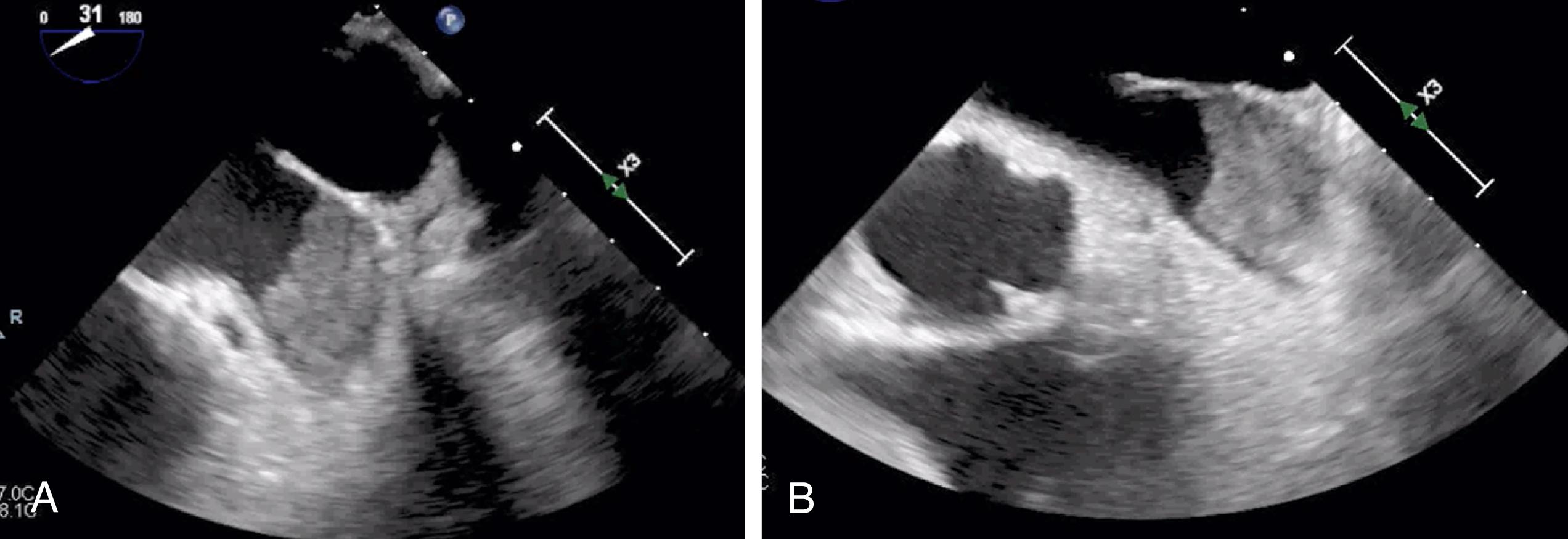 Figure 127.3, A and B, Left atrial and right atrial appendage thrombi seen in the same transesophageal echocardiogram. (Also see Video 127.3A , Video 127.3B .)