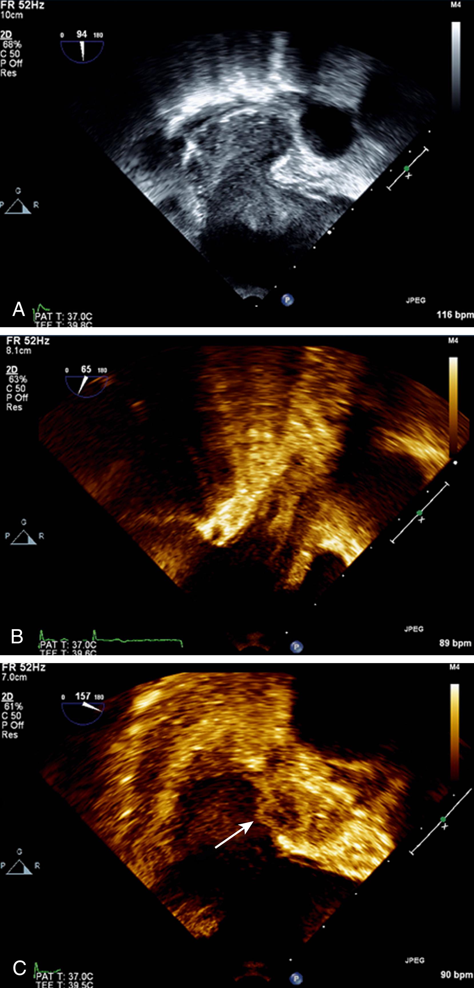 Figure 127.5, Severe (dense) spontaneous echocardiographic contrast ( A ) and left atrial appendage “sludge” or soft thrombus ( B and C ). (Also see Video 127.5A , Video 127.5B .)