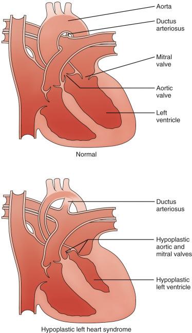 Figure 73.1, Diagram of hypoplastic left heart syndrome.