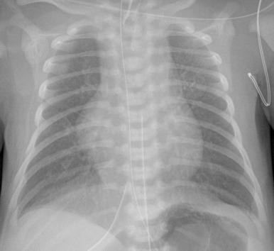 e-Figure 73.2, Newborn with hypoplastic left heart syndrome.