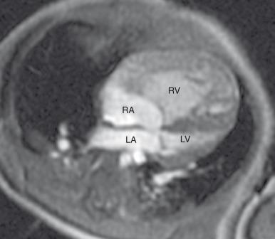 Figure 73.3, Hypoplastic left heart syndrome.