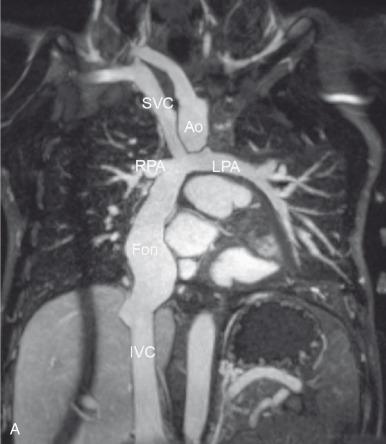 Figure 73.4, Completed Fontan palliation.