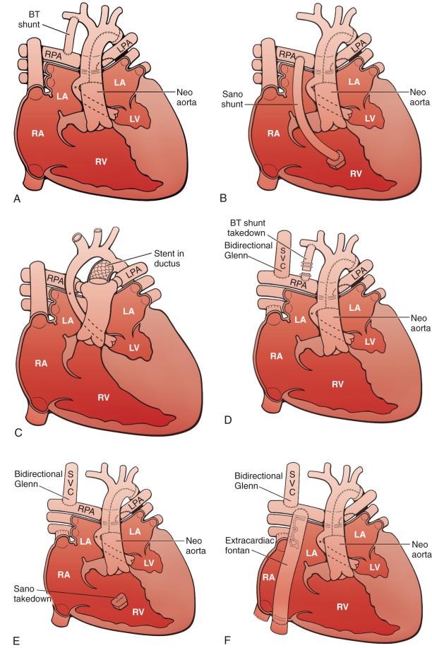 Figure 73.5, Staged reconstruction for hypoplastic left heart syndrome.